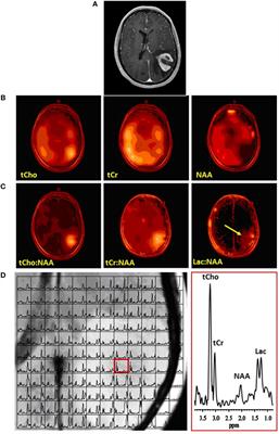 Magnetic Resonance Spectroscopy, Positron Emission Tomography and Radiogenomics—Relevance to Glioma